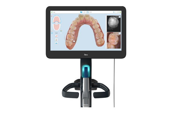 口腔内スキャン