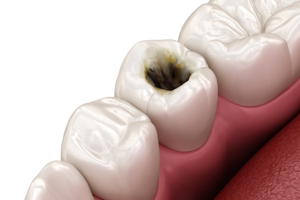 Premolar tooth restoration with filling after caries damage. Medically accurate tooth 3D illustration.