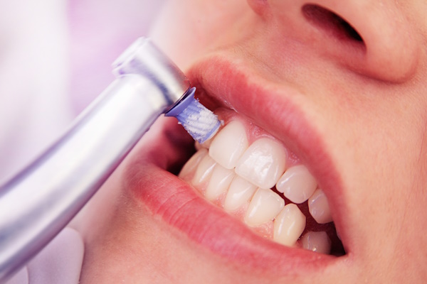 Close-up professionelle Zahnreinigung / die Zähne einer Frau we