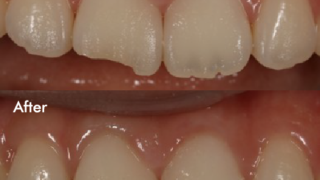 20代女性「歯が欠けた」～ CR充填 - 新宿の歯医者「新宿西口歯科医院